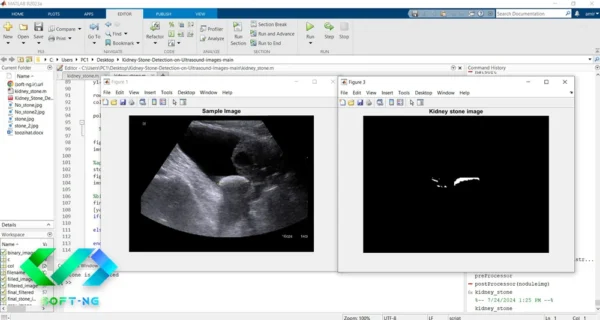 تشخیص خودکار سنگ کلیه در تصاویر اولتراسونیک در متلب